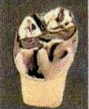 金属冠
