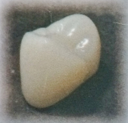 ハイブリッドレジン
ＣＡＤ ＣＡＭ冠（小臼歯）