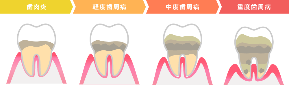 歯周病